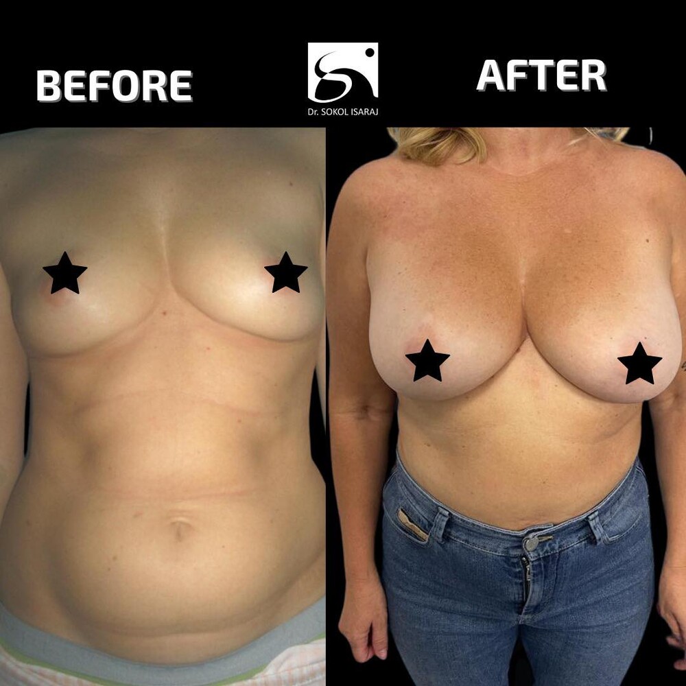 Before and After Result